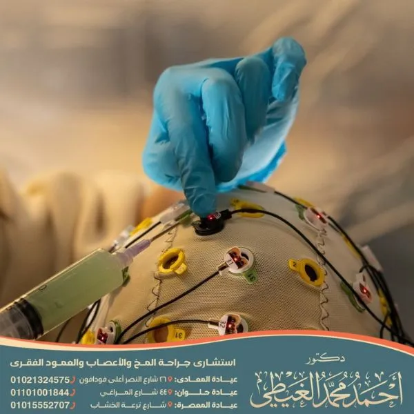 انواع الصرع واعراضه