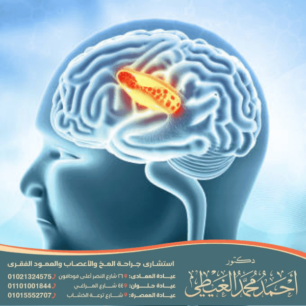 تكلفة دعامة المخ