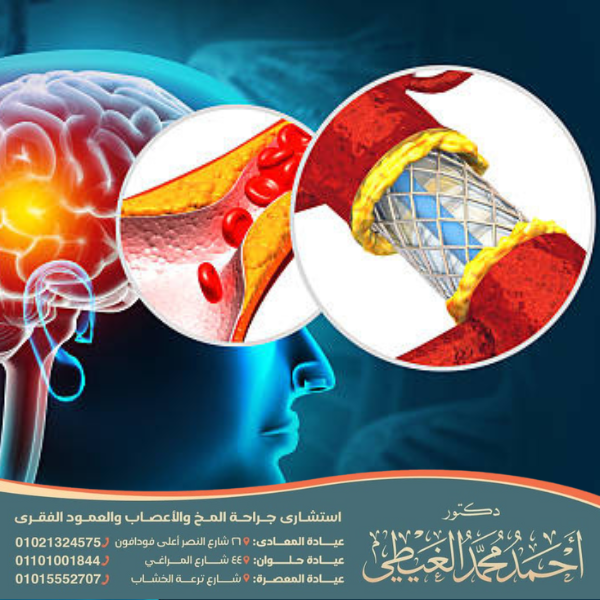 تكلفة دعامة المخ