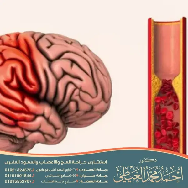 
تكلفة علاج الجلطة الدماغية