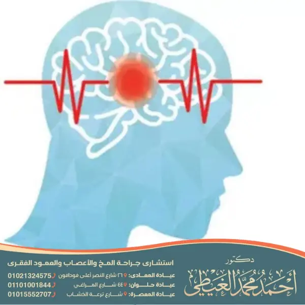 تكلفة علاج الجلطة الدماغية