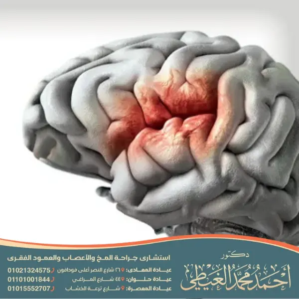 
تكلفة علاج الجلطة الدماغية