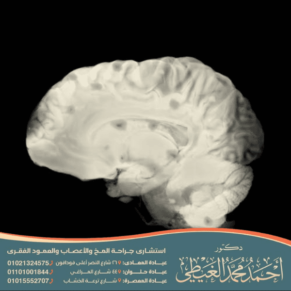 علاج الجسم الثفني في الدماغ