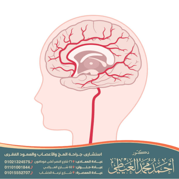 غياب الجسم الثفني عند الأطفال