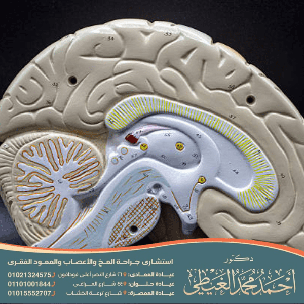 غياب الجسم الثفني عند الأطفال