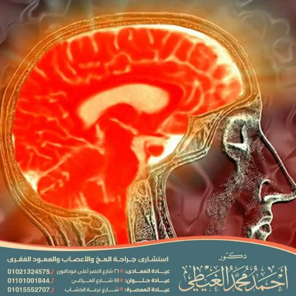 كم تستغرق عملية نزيف الدماغ