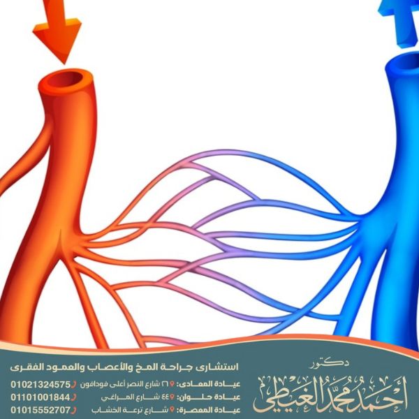 كيف يموت مريض الشريان السباتي