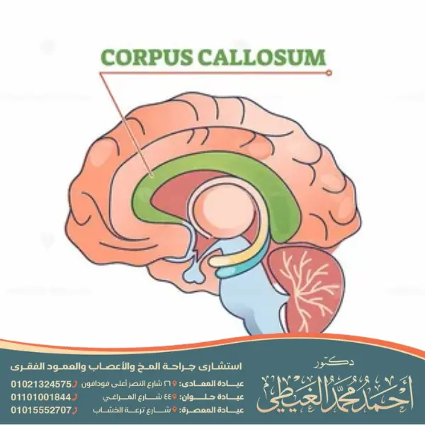 متلازمة الجسم الثفني