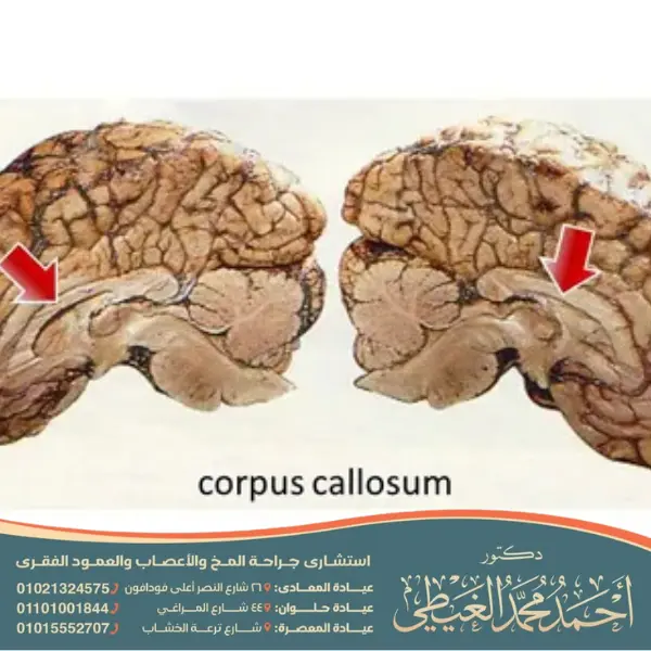 متلازمة الجسم الثفني