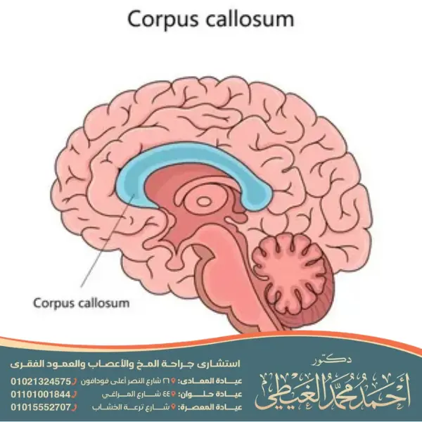 متلازمة الجسم الثفني