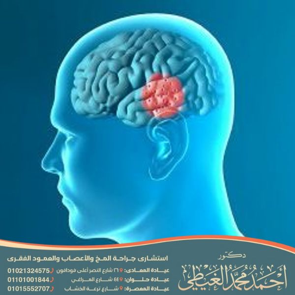 أضرار قسطرة المخ