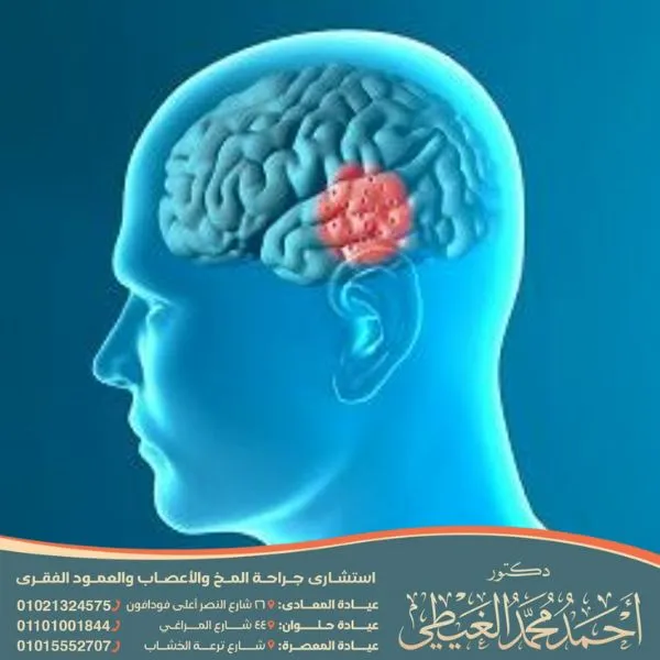 أضرار قسطرة المخ