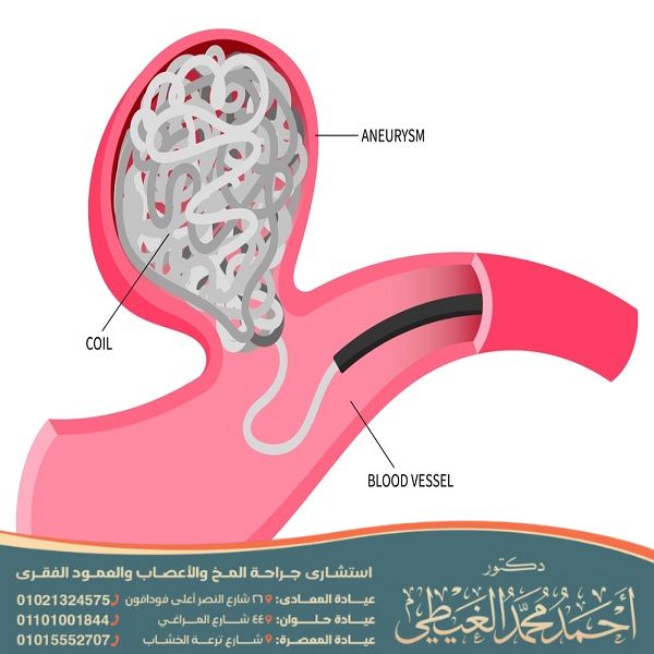 أضرار قسطرة المخ