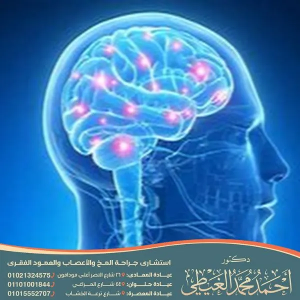 عملية القسطرة الدماغية