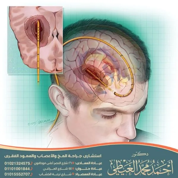 عملية سحب الماء من الرأس عند الكبار