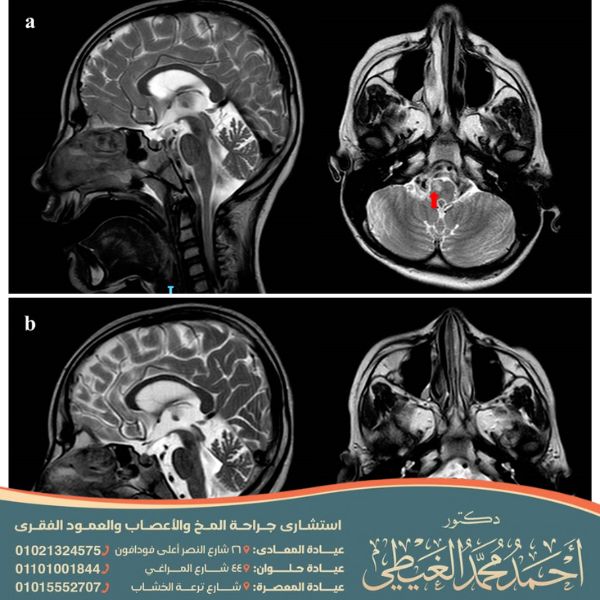 أعراض الصرع المستعصي