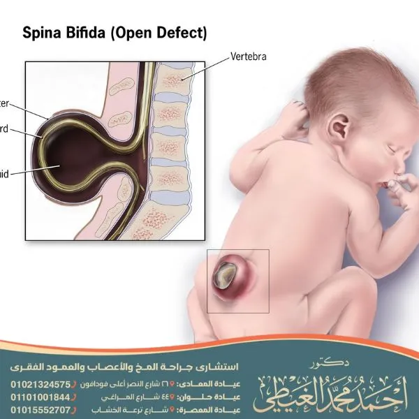 أنواع القيلة السحائية