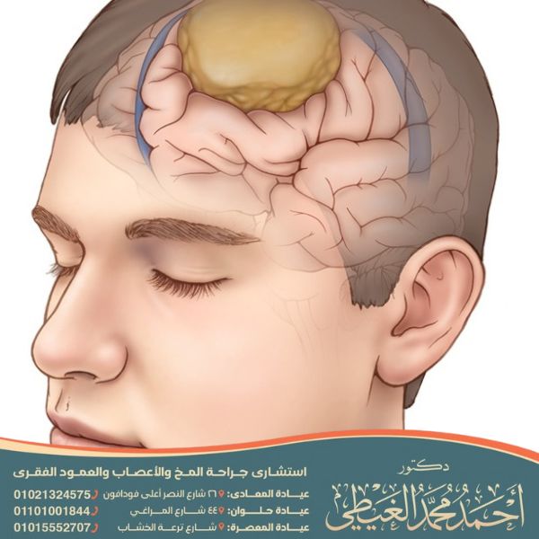 تجربتي مع الورم السحائي