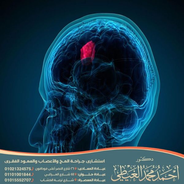 تجربتي مع الورم السحائي