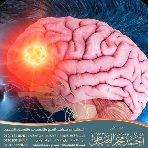تجربتي مع الورم السحائي