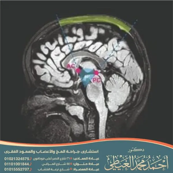 تسرب السائل النخاعي القحفي