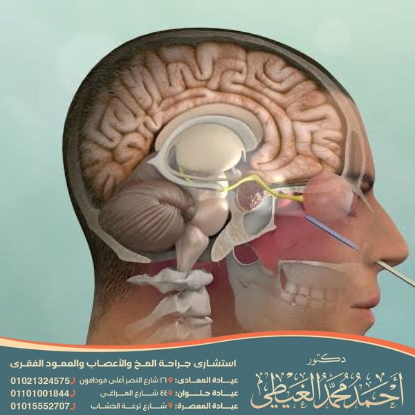 تكلفة عملية تسرب السائل النخاعي