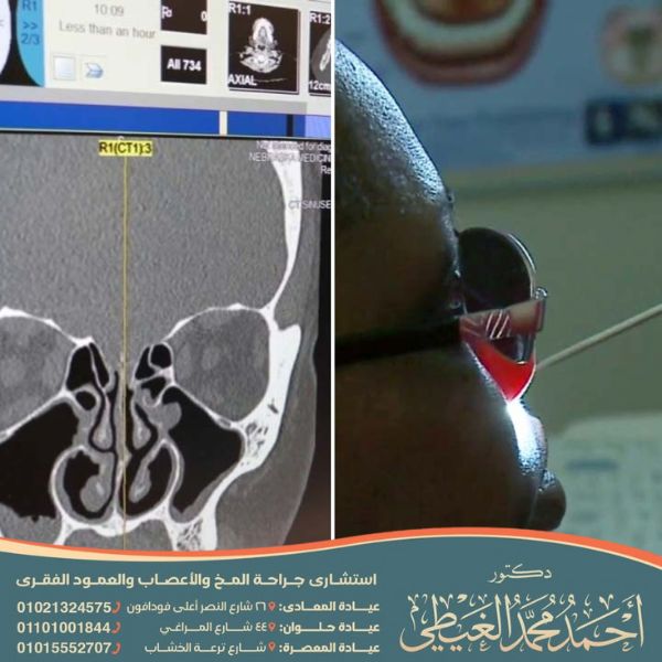 تكلفة عملية تسرب السائل النخاعي