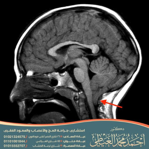 متلازمة أرنولد كياري