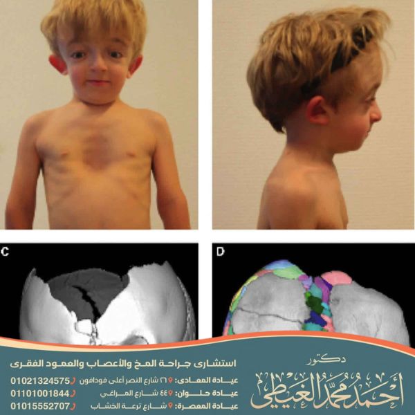 متلازمة أرنولد كياري
