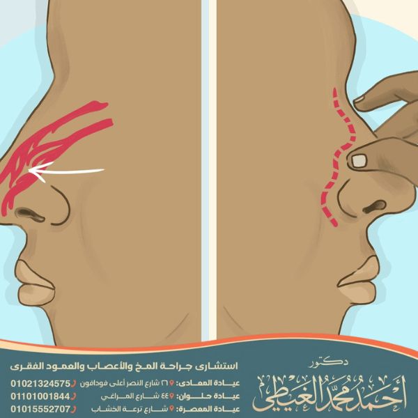 نزول سائل النخاع الشوكي من الأنف