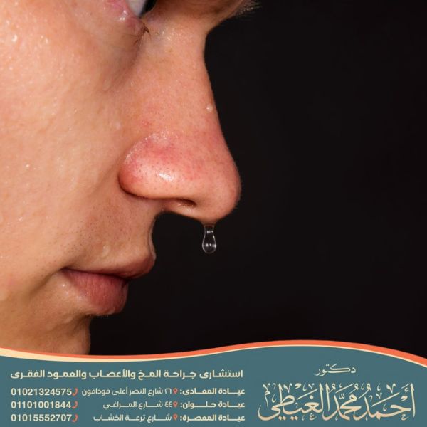 نزول سائل النخاع الشوكي من الأنف