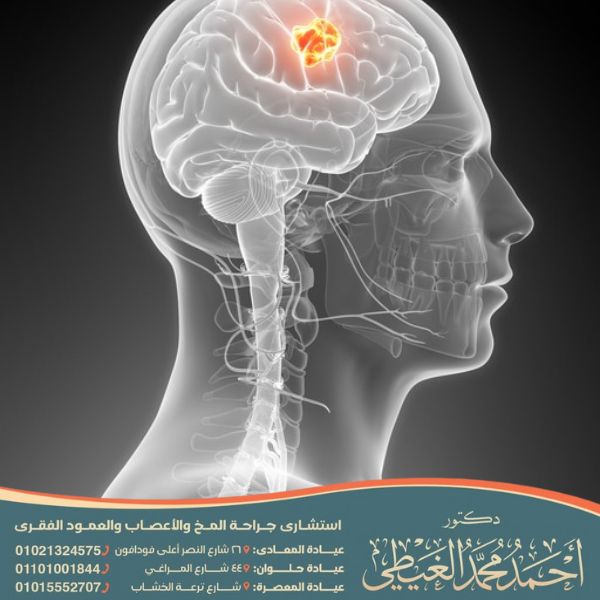 نسبة الشفاء من الورم السحائي