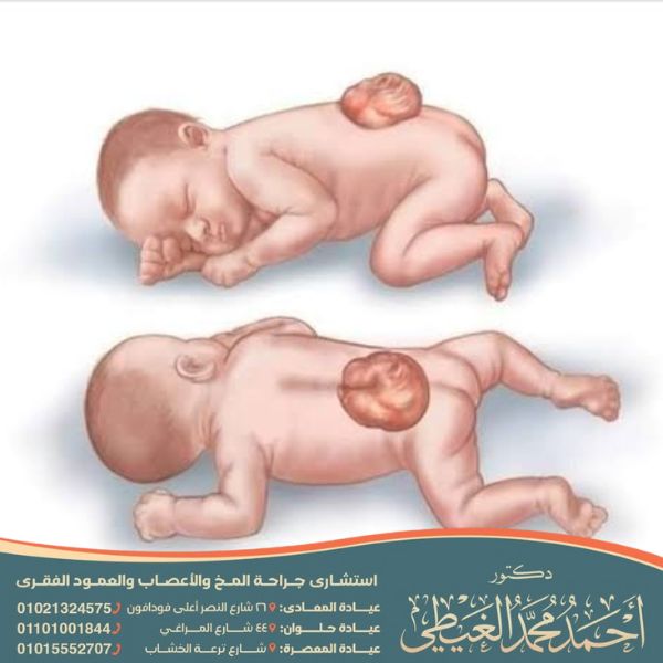 نسبة نجاح عملية القيلة السحائية