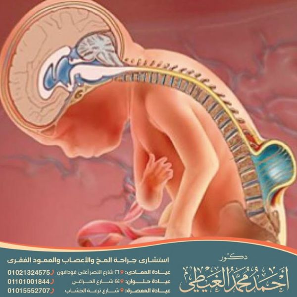 نسبة نجاح عملية القيلة السحائية