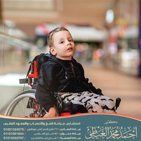 أعراض ضمور العضلات عند الأطفال