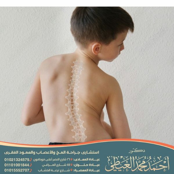 اصلاح اعوجاج العمود الفقري