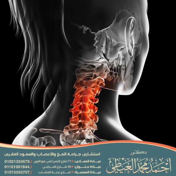 التهاب جذور الأعصاب العنقية