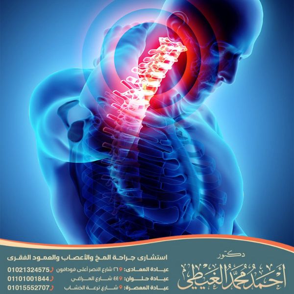 التهاب جذور الأعصاب العنقية