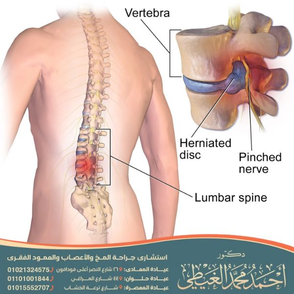 التهاب جذور الأعصاب القطنية