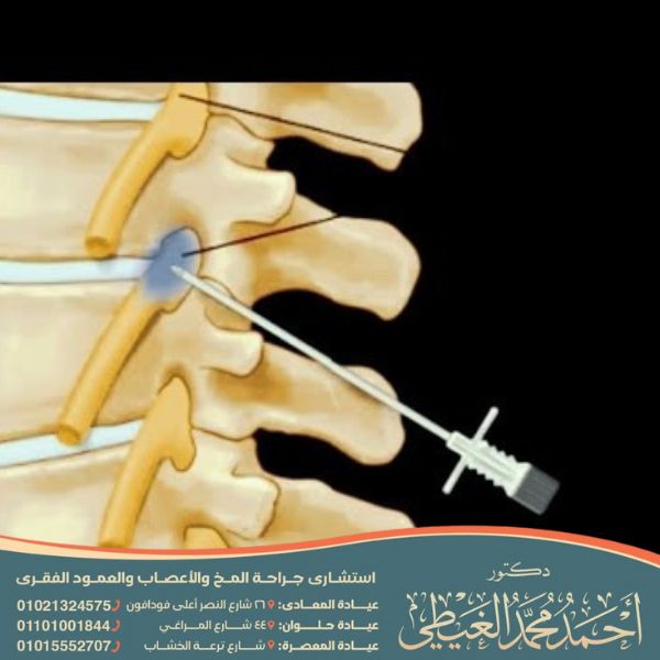 تكلفة عملية حقن جذور الأعصاب