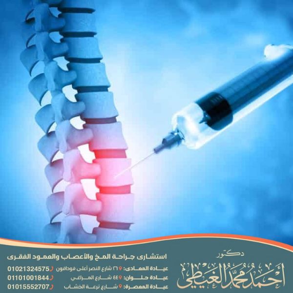 حقن جذور الأعصاب والتردد الحرارى