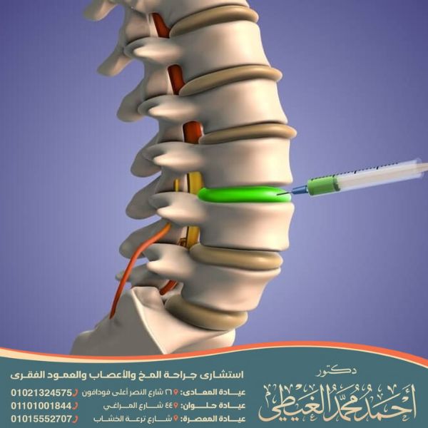 حقن جذور الأعصاب والتردد الحرارى