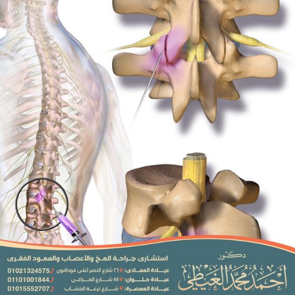 حقن جذور الأعصاب والتردد الحرارى