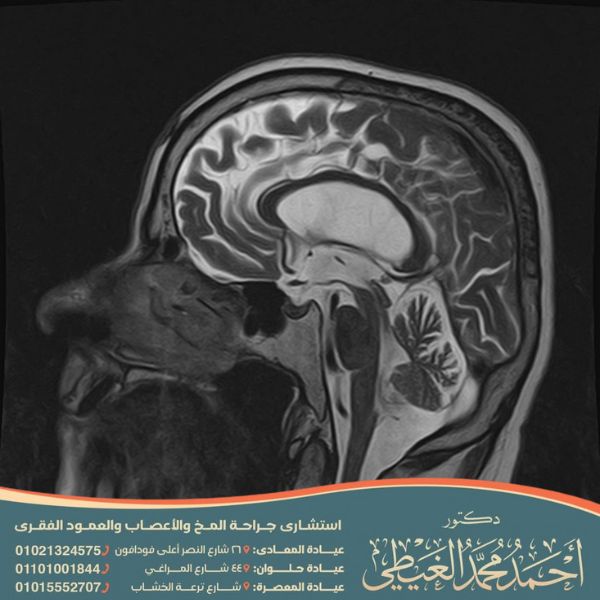 عملية الاستسقاء الدماغي بالمنظار