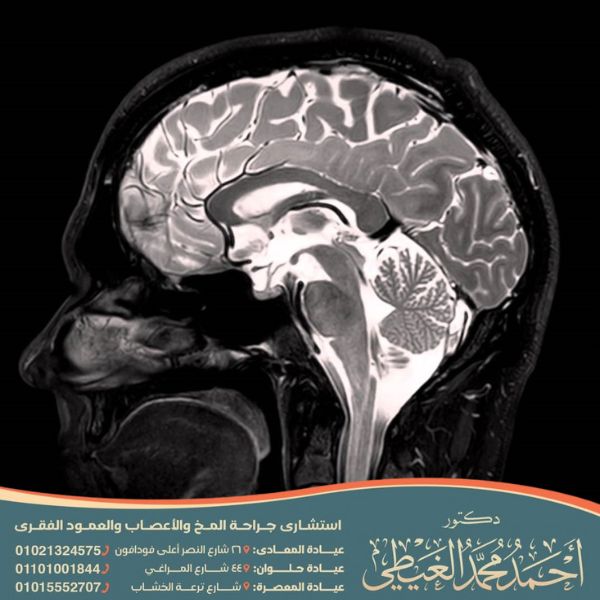 هل يعيش مريض استسقاء الدماغ