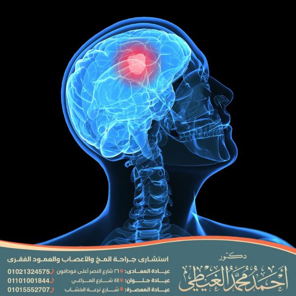 اثار الورم في الرأس