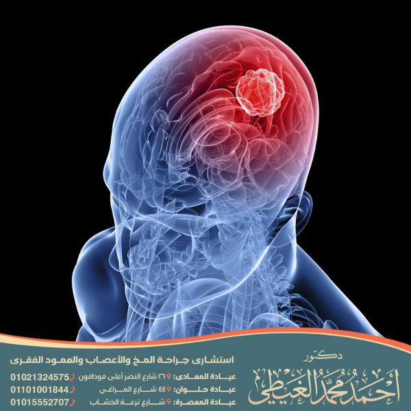 اثار الورم في الرأس