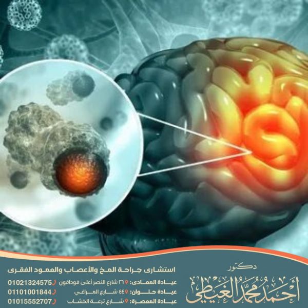 اعراض ورم الدماغ المبكره