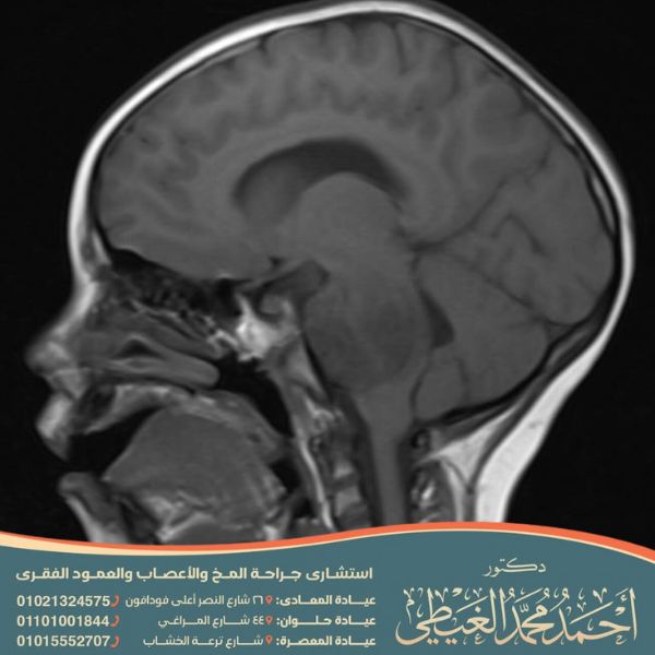 اعراض ورم الراس للاطفال