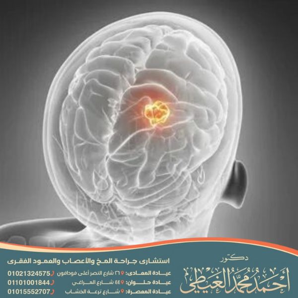 اعراض ورم الراس من الخلف